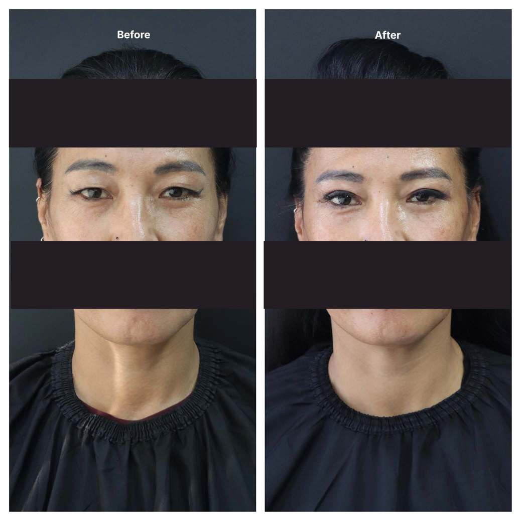 Eyelid Surgery KOQ10